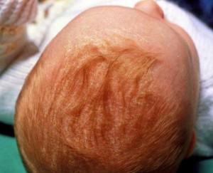 Корочки на голове у новорожденного